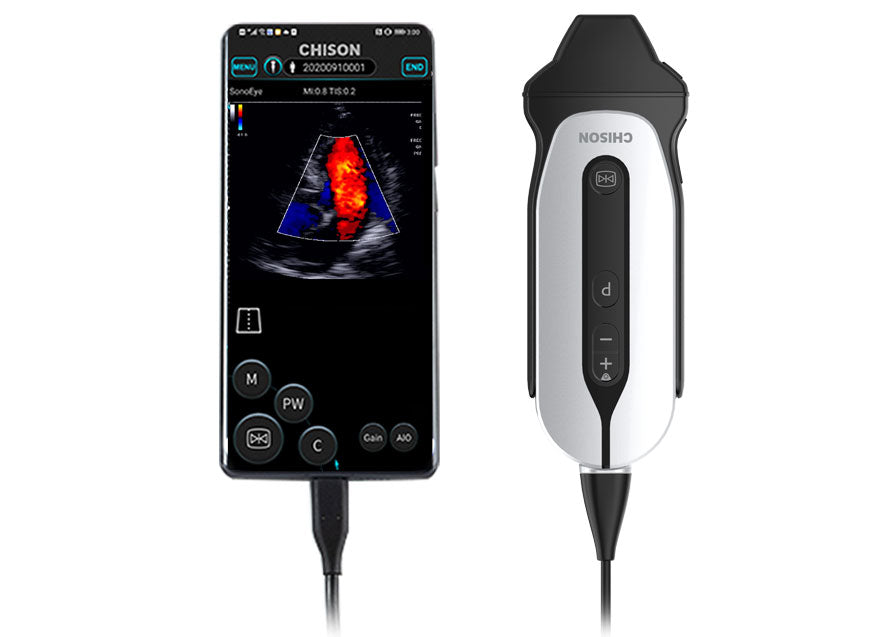 Chison Sonoeye P3